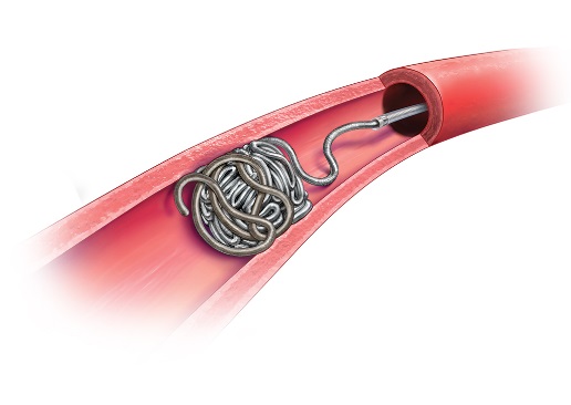 The Penumbra Occlusion Device 
